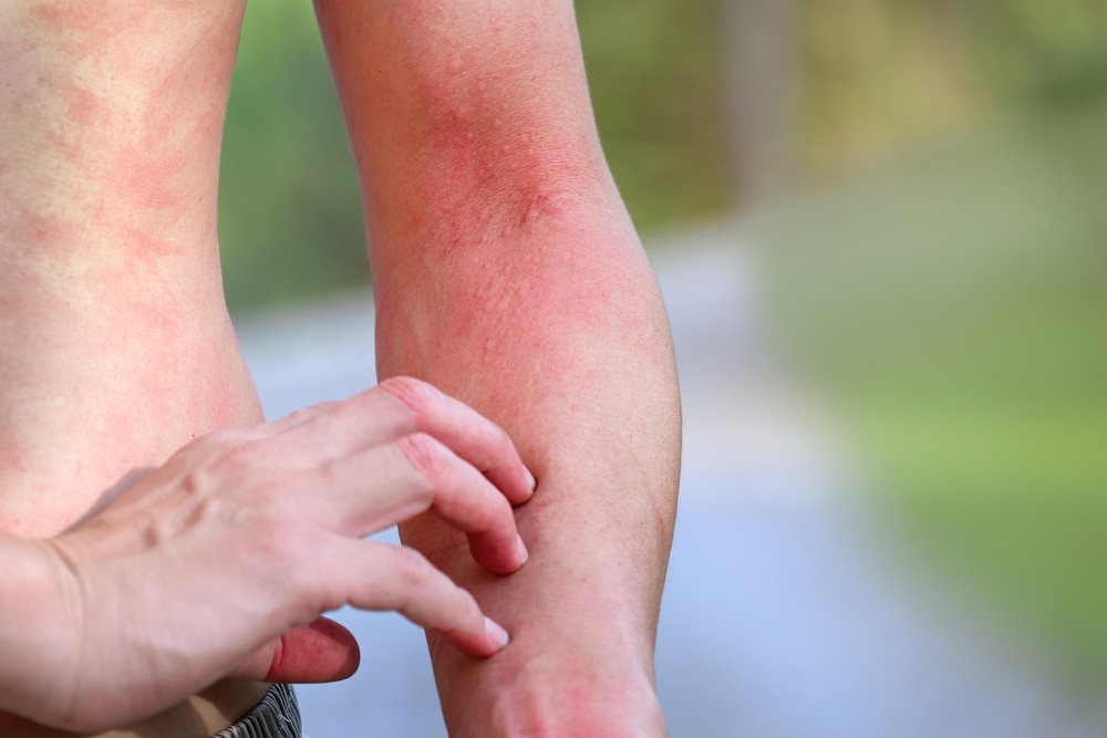 Man scratching his arms